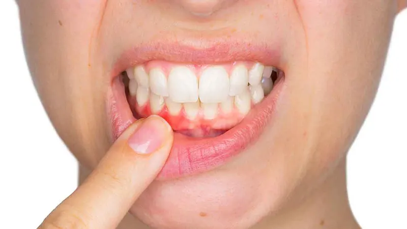 Viêm nướu, hỏng răng gốc nếu mão sứ không khít sát khi bọc sứ